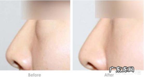 有眼袋是什么原因?