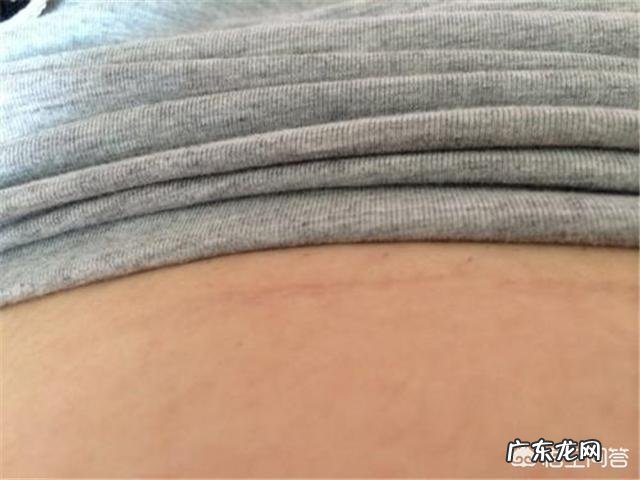 为什么剖腹产刀口处疤痕比较明显?