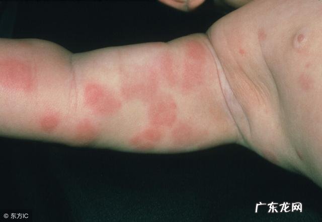 过敏性紫癜是否真的很难痊愈?