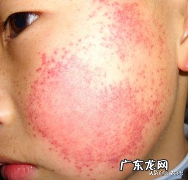 过敏性紫癜是否真的很难痊愈?