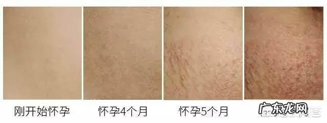 怀孕多久会长妊娠纹？为什么会长妊娠纹？