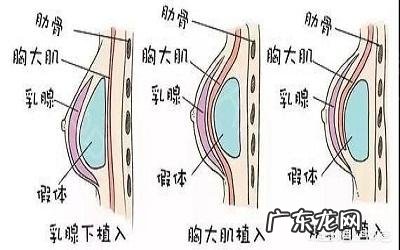 隆胸后，能给宝宝喂奶吗？需要注意什么？