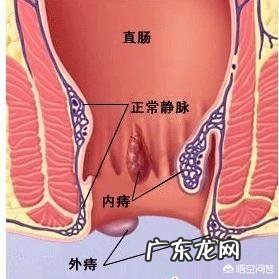 准妈妈孕期痔疮很痛苦,如何提前预防?