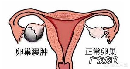 卵巢囊肿都是怎么造成的呢?