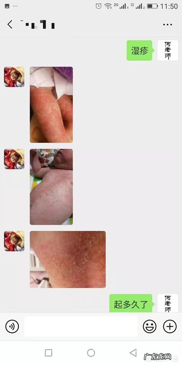 大人会得湿疹吗?