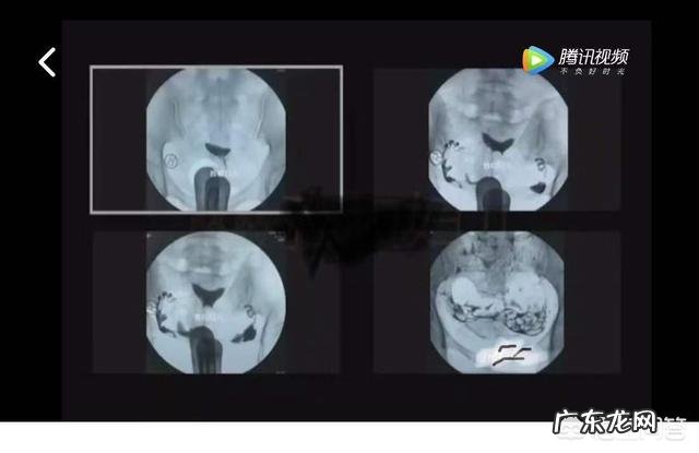 输卵管造影片子该怎么看呢?