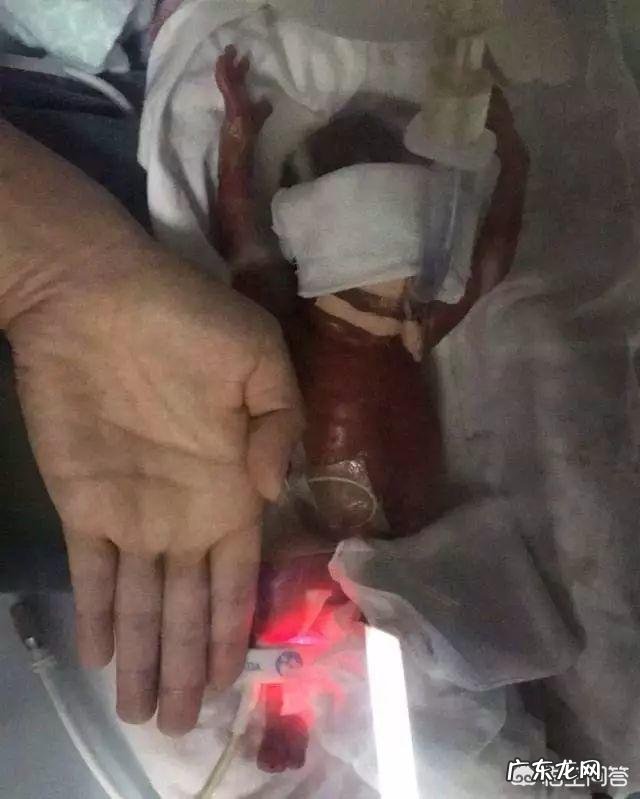 早产儿该怎样护理?