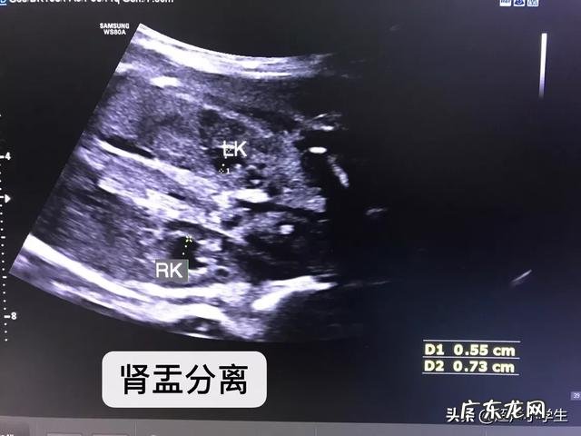 怀孕生男孩,胎心率是每分钟多少下?怀孕时应注意什么?