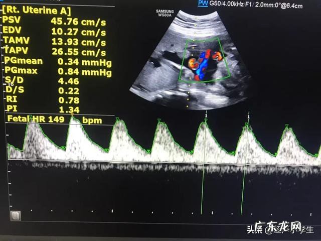 怀孕生男孩,胎心率是每分钟多少下?怀孕时应注意什么?