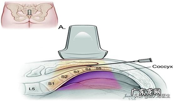 痔疮手术可以全麻吗?