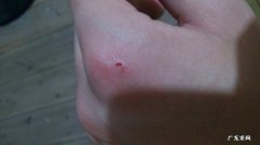 被老鼠抓伤了怎么办