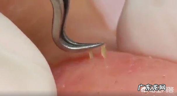 怎么缩小毛孔去黑头?