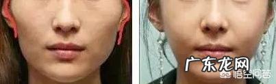 做一个面部下部磨骨整形多少钱,都有什么风险吗?
