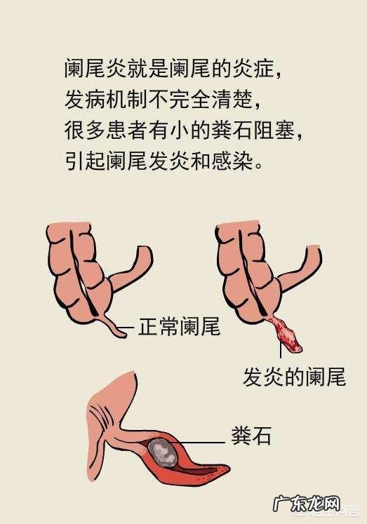 小孩子阑尾炎什么症状?