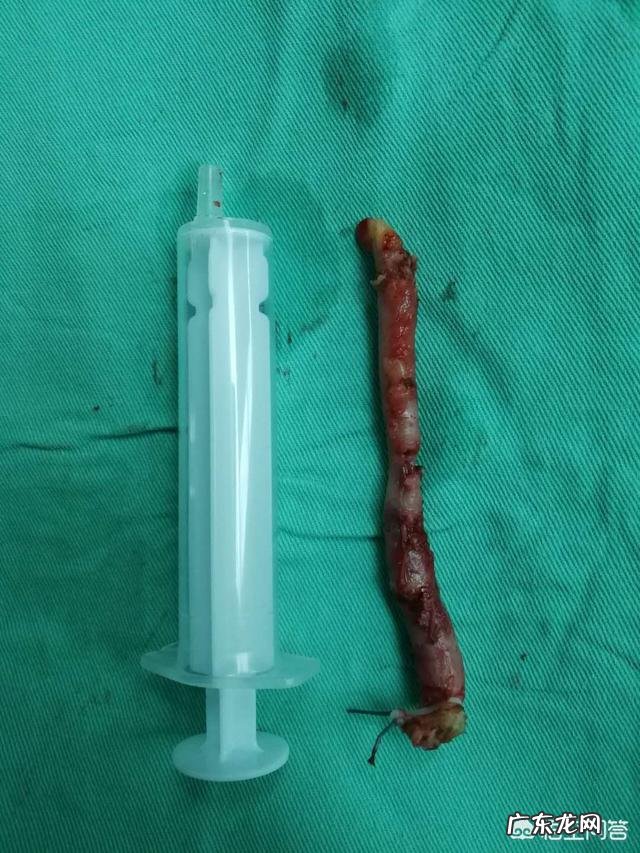 阑尾炎手术后会有什么变化吗?