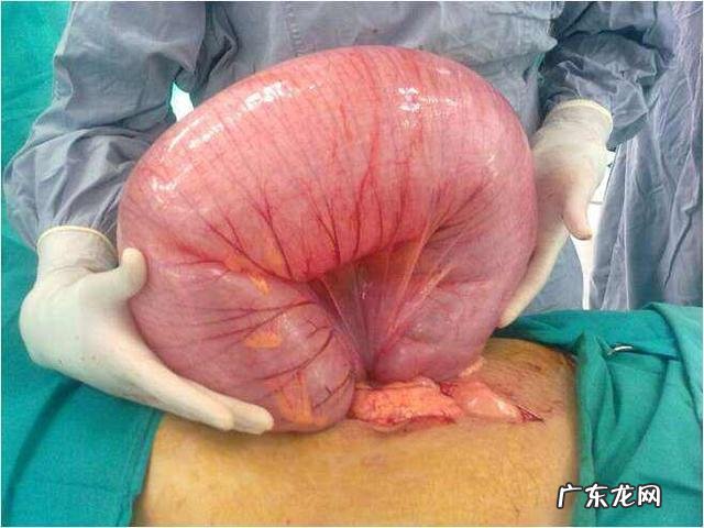 大便长期排不出,清肠毒吃什么好?