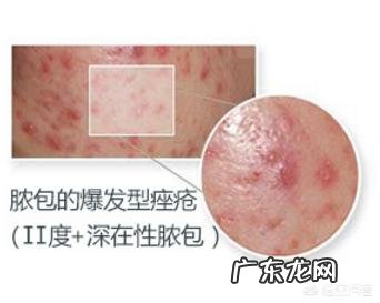 酱油吃多了会影响痘痘愈合吗?