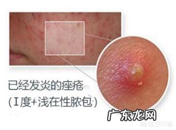 酱油吃多了会影响痘痘愈合吗?