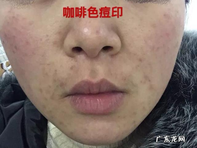 如何清除脸上的痘印啊?