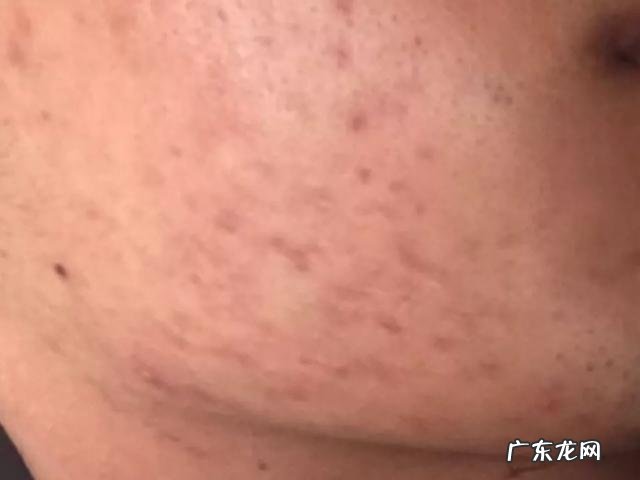 如何清除脸上的痘印啊?