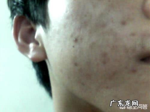 如何清除脸上的痘印啊？