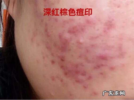如何清除脸上的痘印啊?