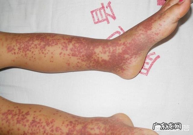 小孩有过敏性紫癜，应该怎么治疗？