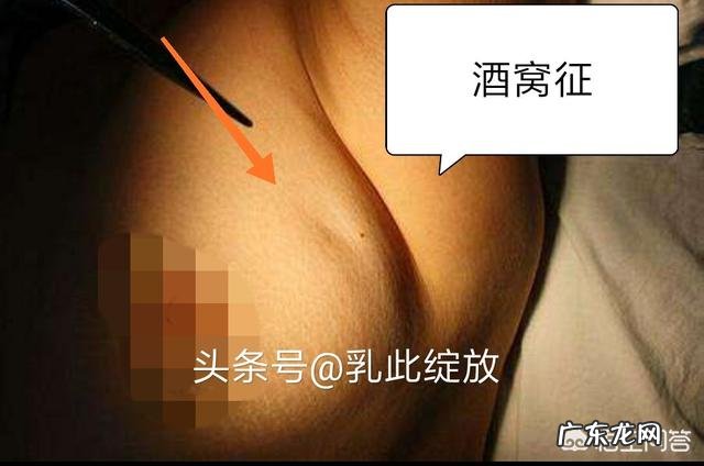 如何发现早期的乳腺癌?