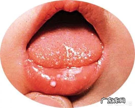 婴儿长口疮怎么办?