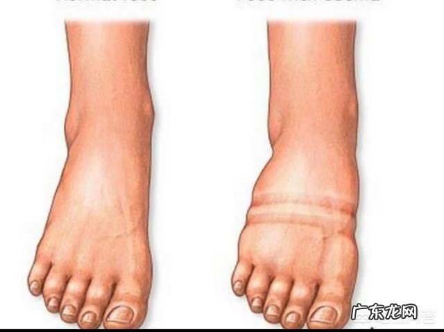 脸部水肿啥原因?