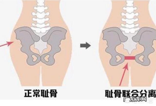 生产后耻骨联合分离造成全身瘫痪一样卧床俩月才恢复,是什么原因造成的?