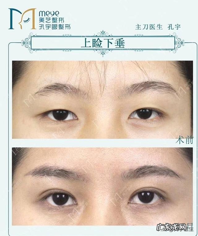 顺便怎么样可以让眼睛变大点,不动手术那种 眼睛太小会有怎么样的烦恼?