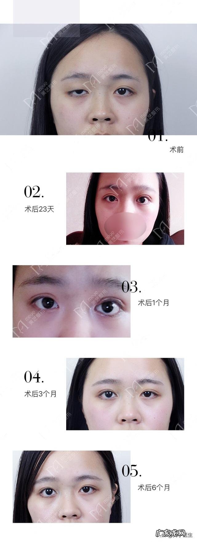 顺便怎么样可以让眼睛变大点,不动手术那种 眼睛太小会有怎么样的烦恼?