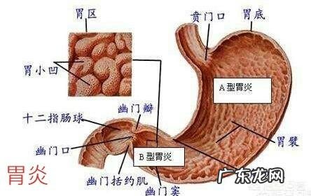 慢性胃炎有哪些症状表现，怎么缓解？