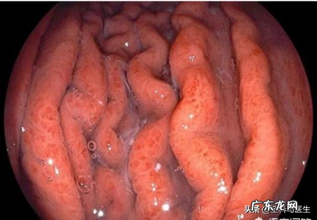 慢性胃炎有哪些症状表现,怎么缓解?