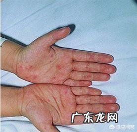 乙肝病毒携带者如果发病会有哪些症状出现？