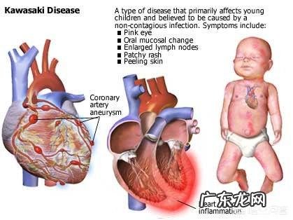 小孩川崎病是什么病?