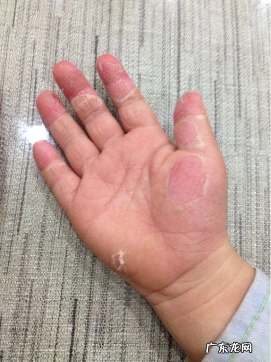 手脱皮是怎么回事?