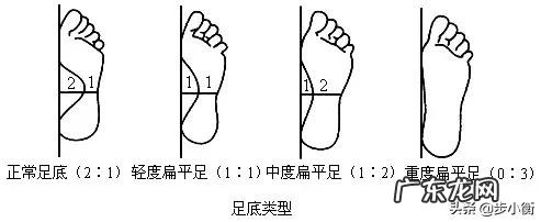 怎么看扁平足?
