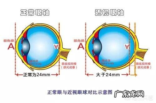眼睛度数三百度左右,这是真性近视还是假性近视?有什么依据?