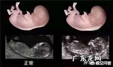 什么时候应该做唐氏筛查,要注意什么?