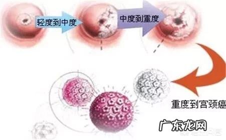 宫颈癌早期有什么症状?