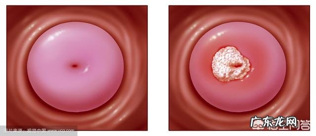 宫颈癌早期有什么症状?