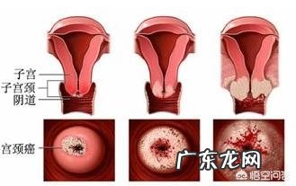 宫颈癌早期有什么症状?