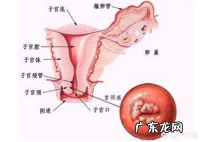 宫颈癌早期有什么症状？