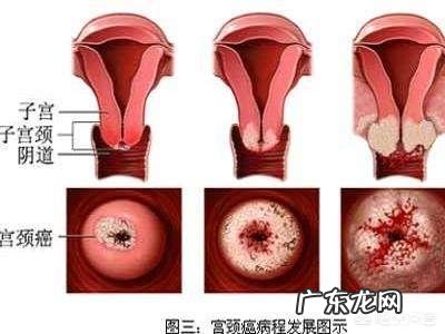 宫颈癌早期有什么症状？