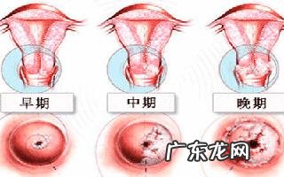 宫颈癌早期有什么症状?