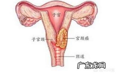 宫颈癌早期有什么症状?