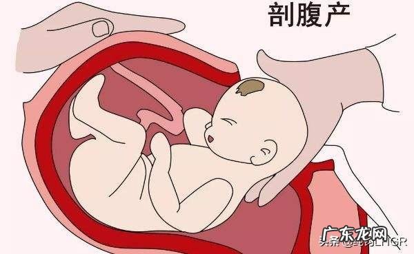 剖腹产腰痛真的是后遗症吗?如何护理可以改善?