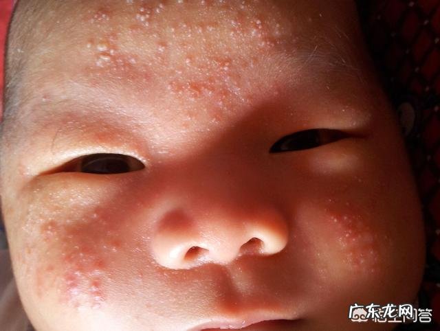 宝宝老是脸上反复起一些小红点怎么办?